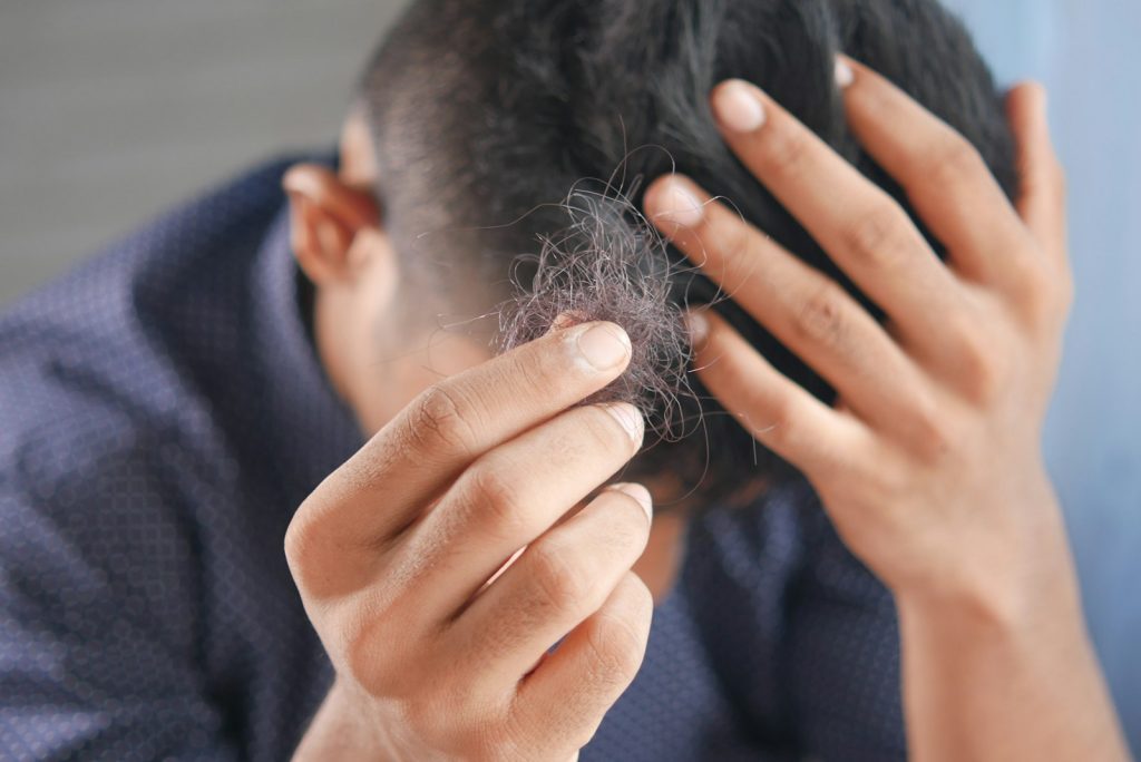 Man examining thinning hair on his crown, with loose strands in his hand