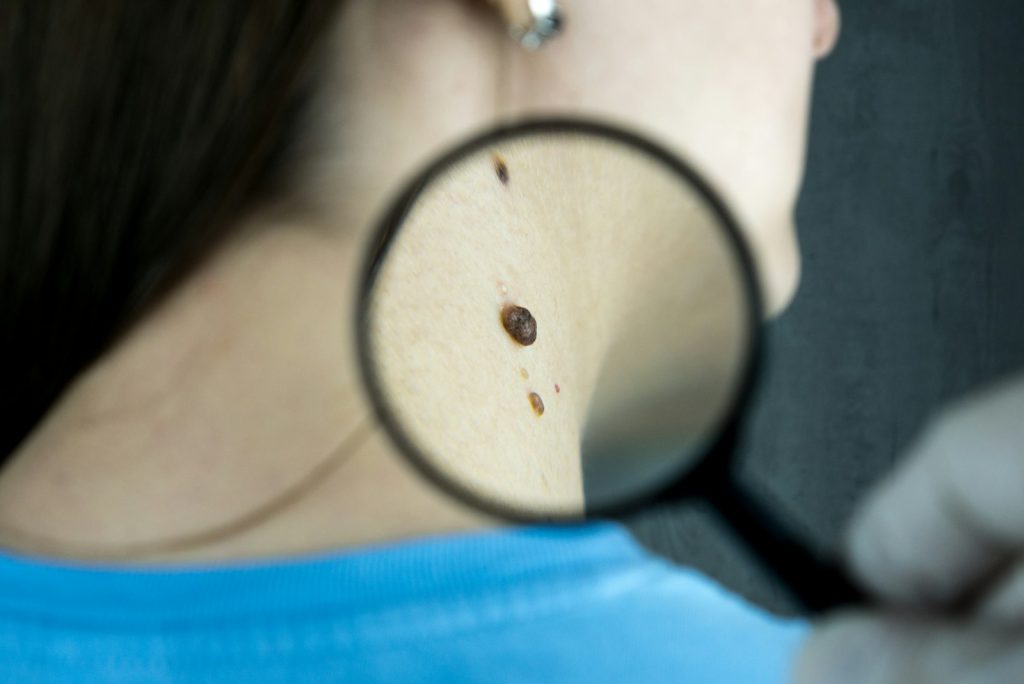 A mole on the skin being examined closely with a magnifier