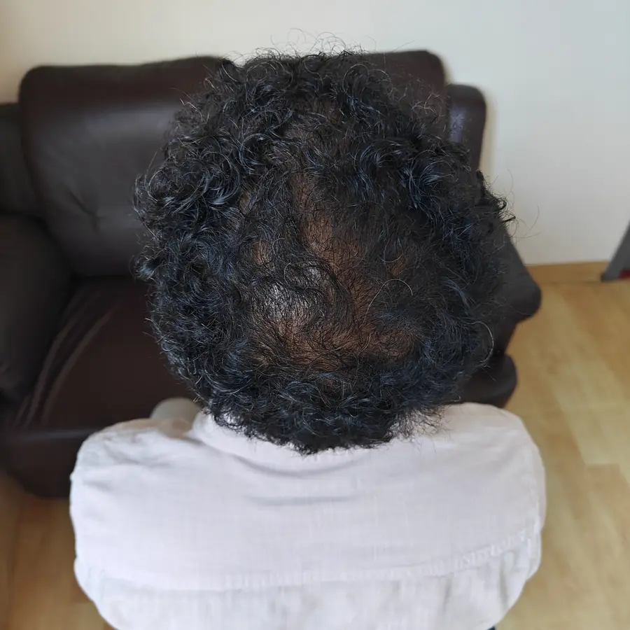 After: Hair transplant, crown