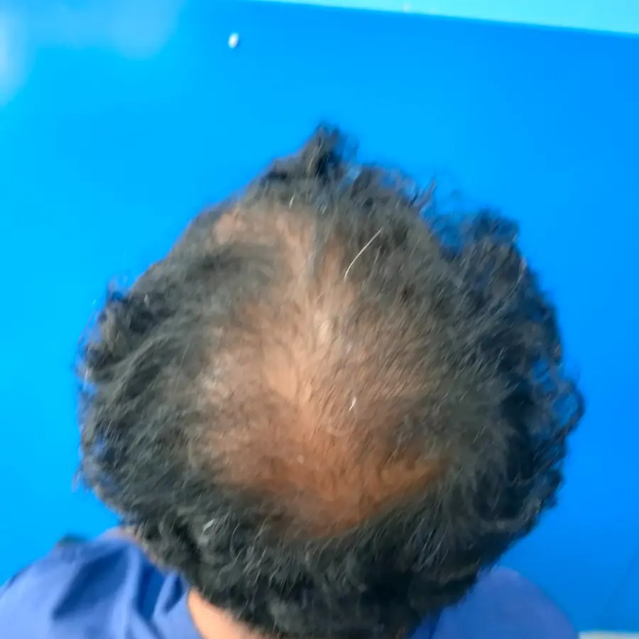 Before: Hair transplant, crown