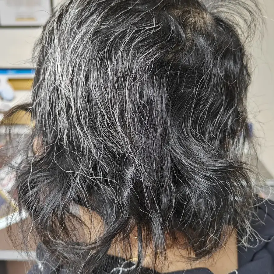 After: Alopecia totalis