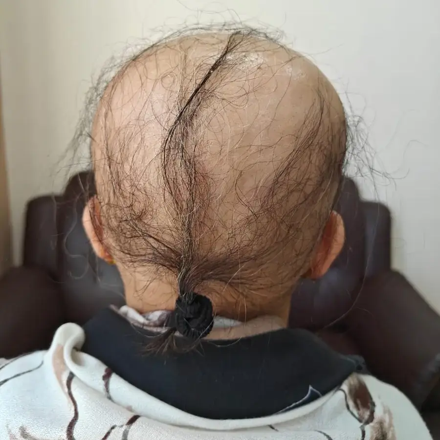 Before: Alopecia totalis