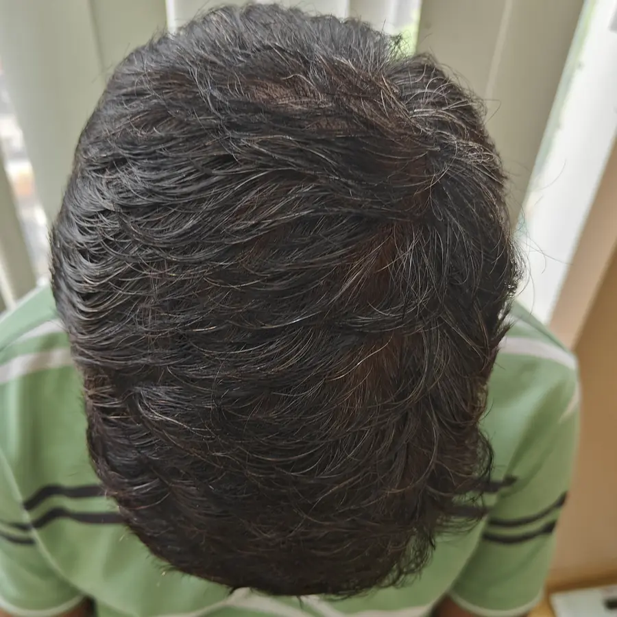 After: Hair transplant, front and top