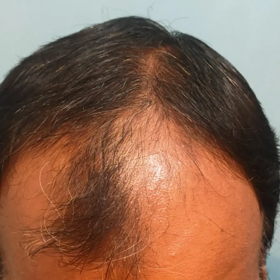 Before: Hair transplant, front and top