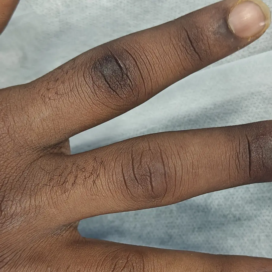 After: Warts on the fingers