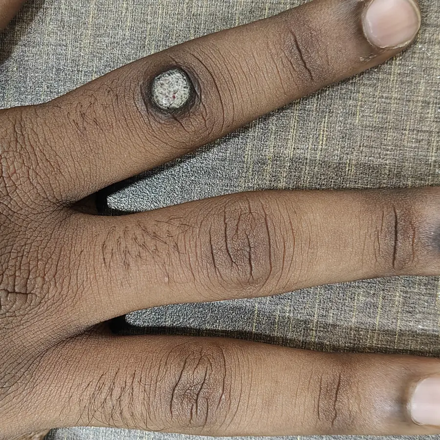 Before: Warts on the fingers