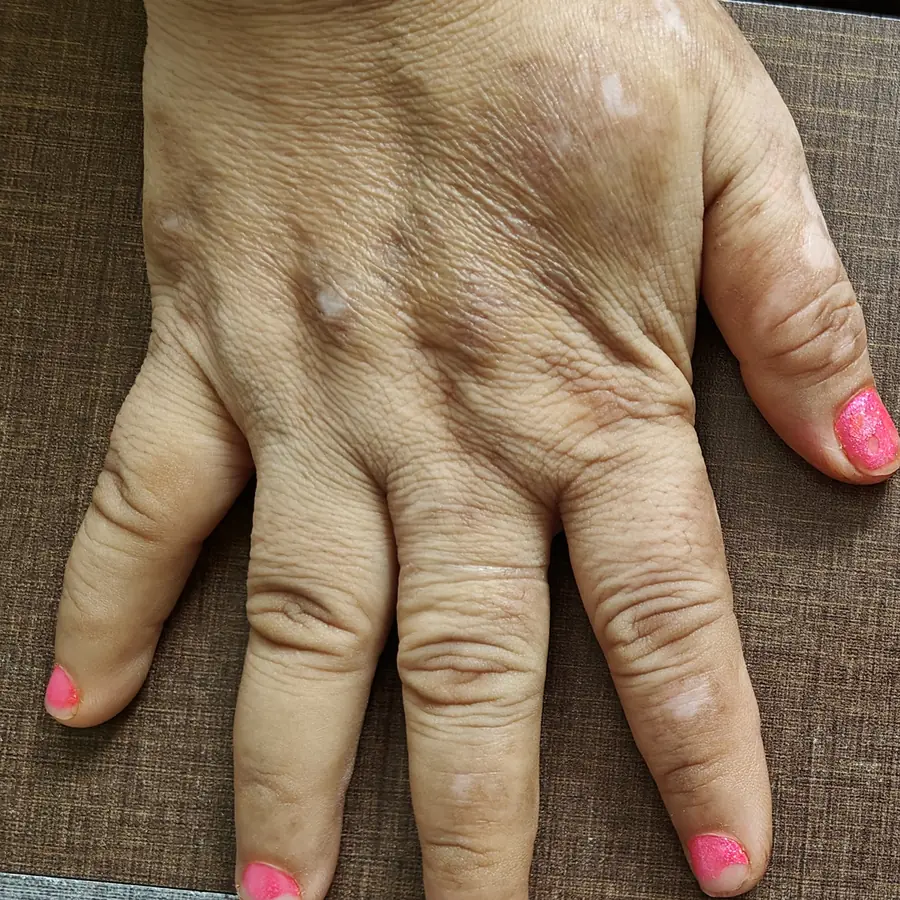 After: Psoriasis on the hand