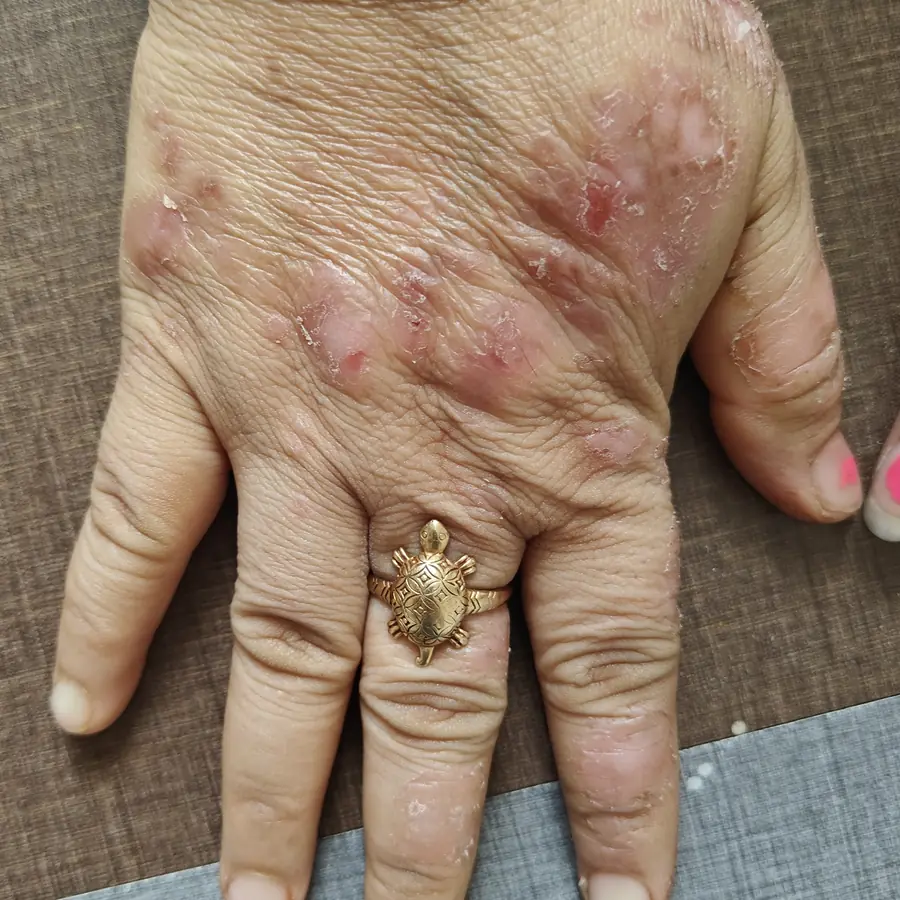 Before: Psoriasis on the hand