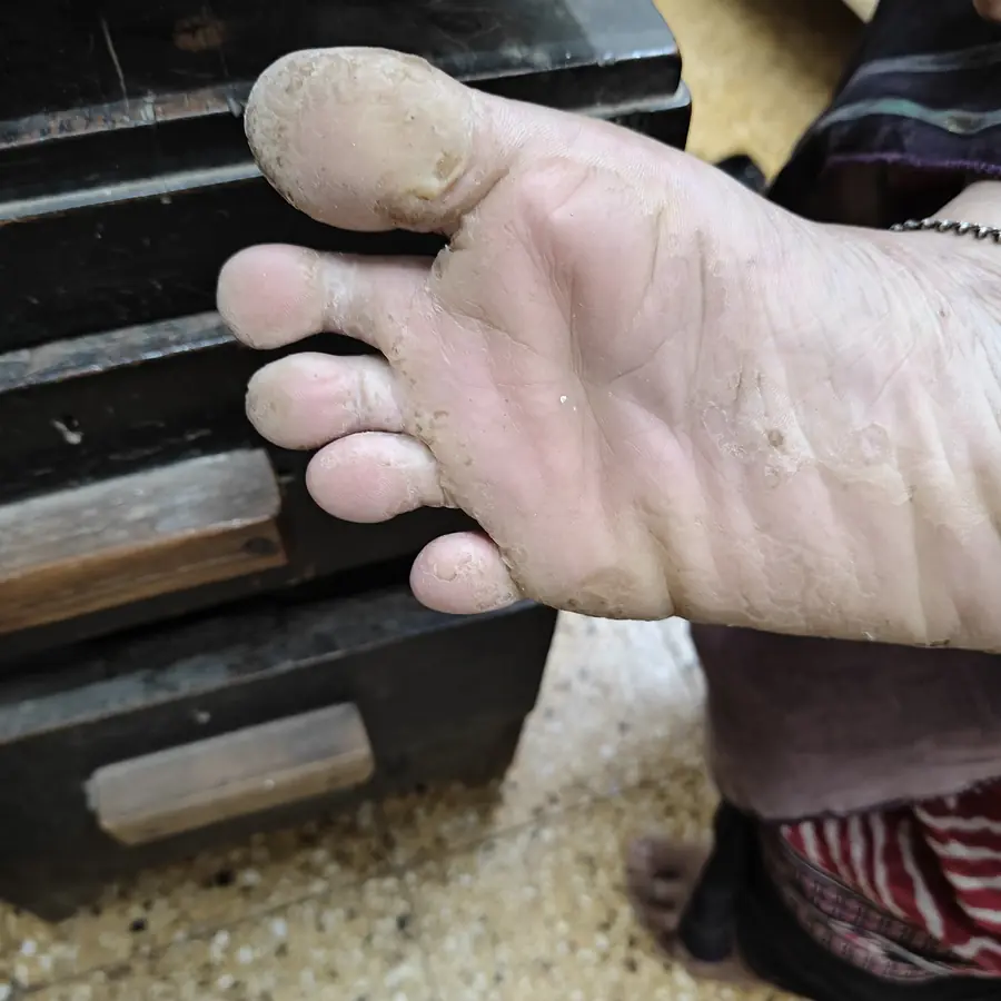 Before: Pitted keratolysis (sole)
