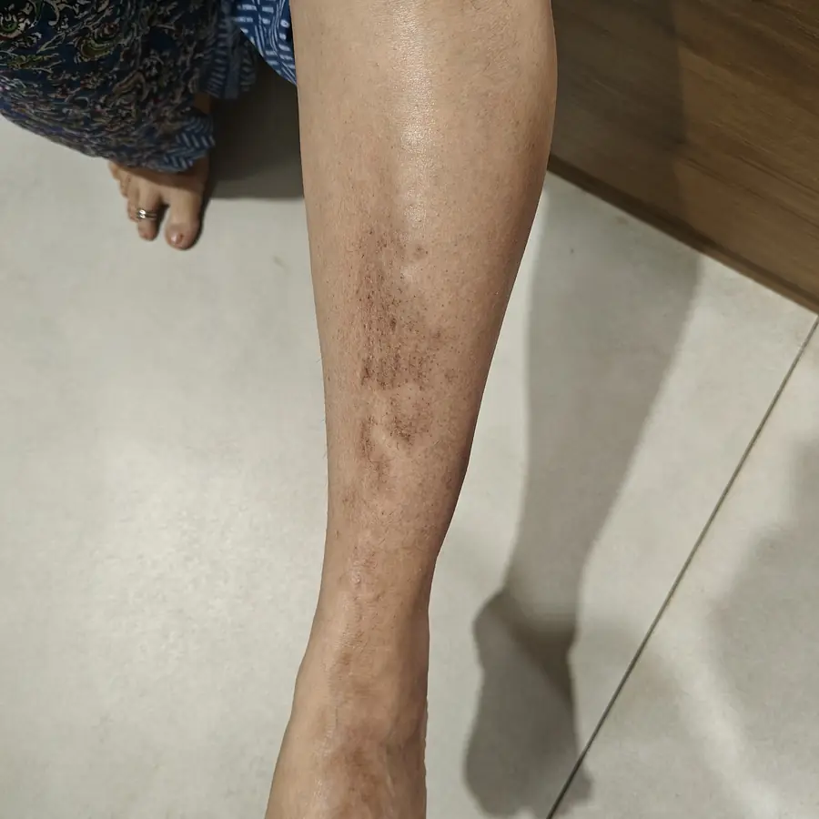 After: Psoriasis on the legs
