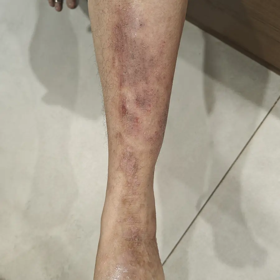 Before: Psoriasis on the legs