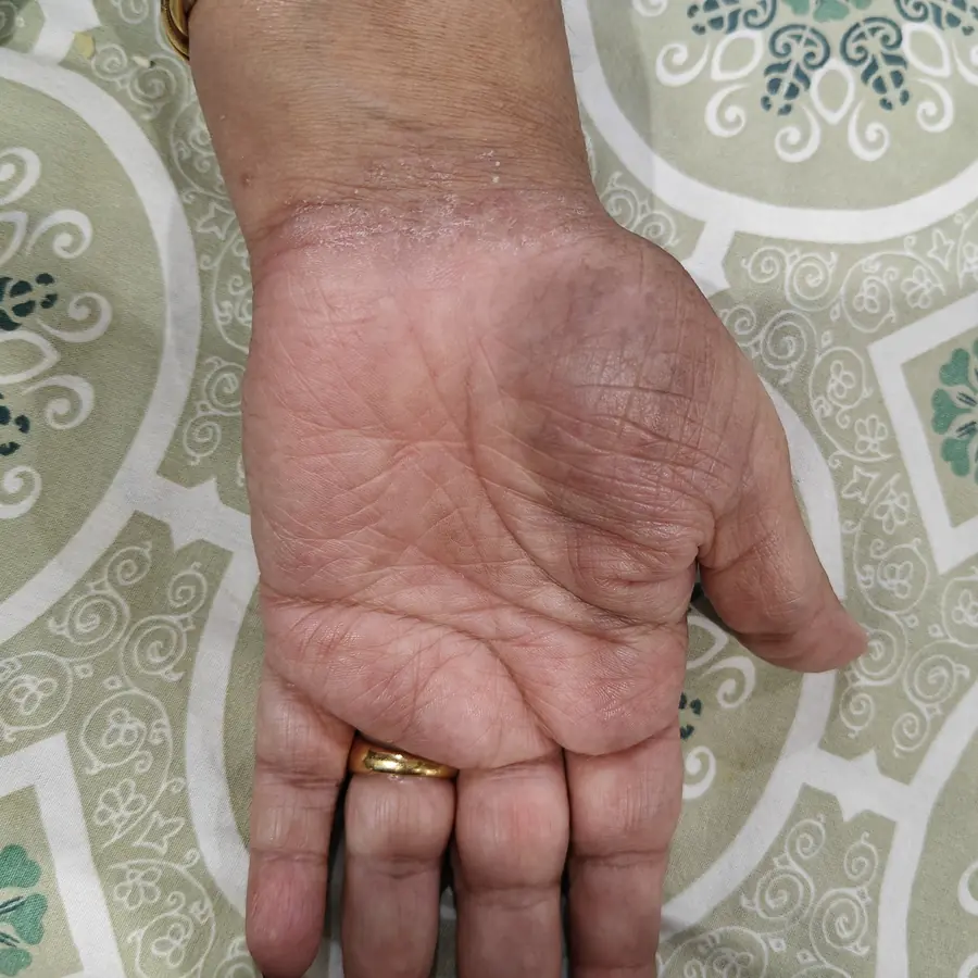 After: Psoriasis on the palm