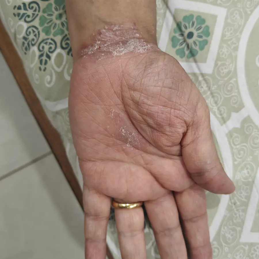 Before: Psoriasis on the palm