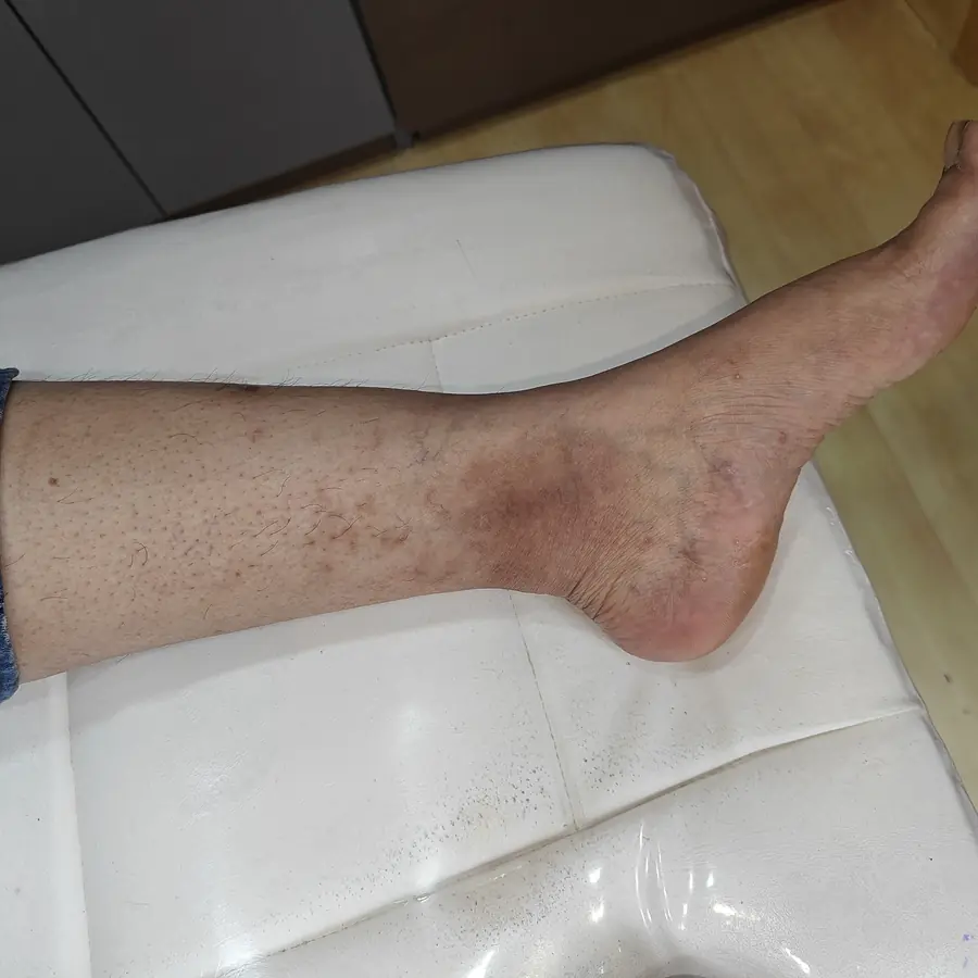 After: Psoriasis-like dermatitis