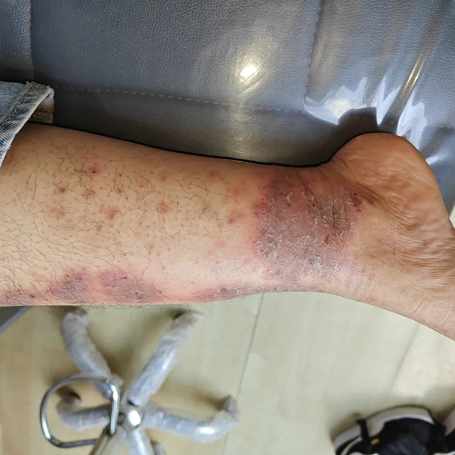Before: Psoriasis-like dermatitis