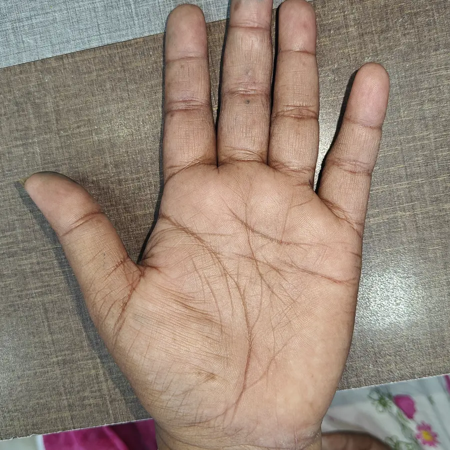 After: Palmar psoriasis