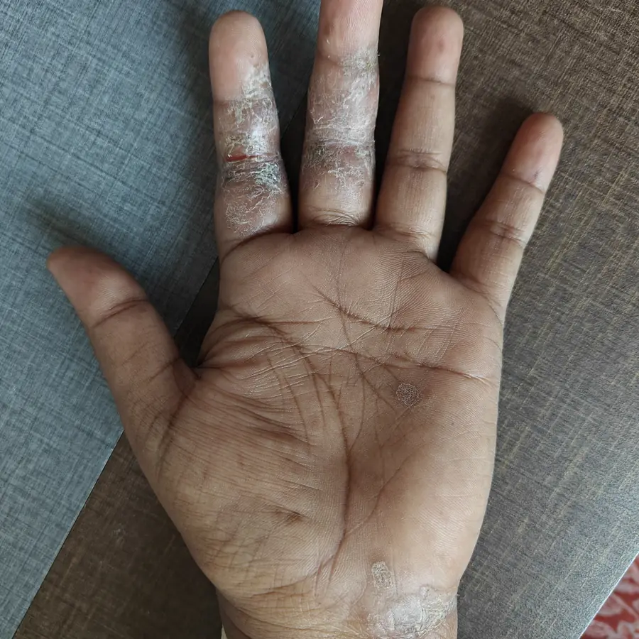 Before: Palmar psoriasis