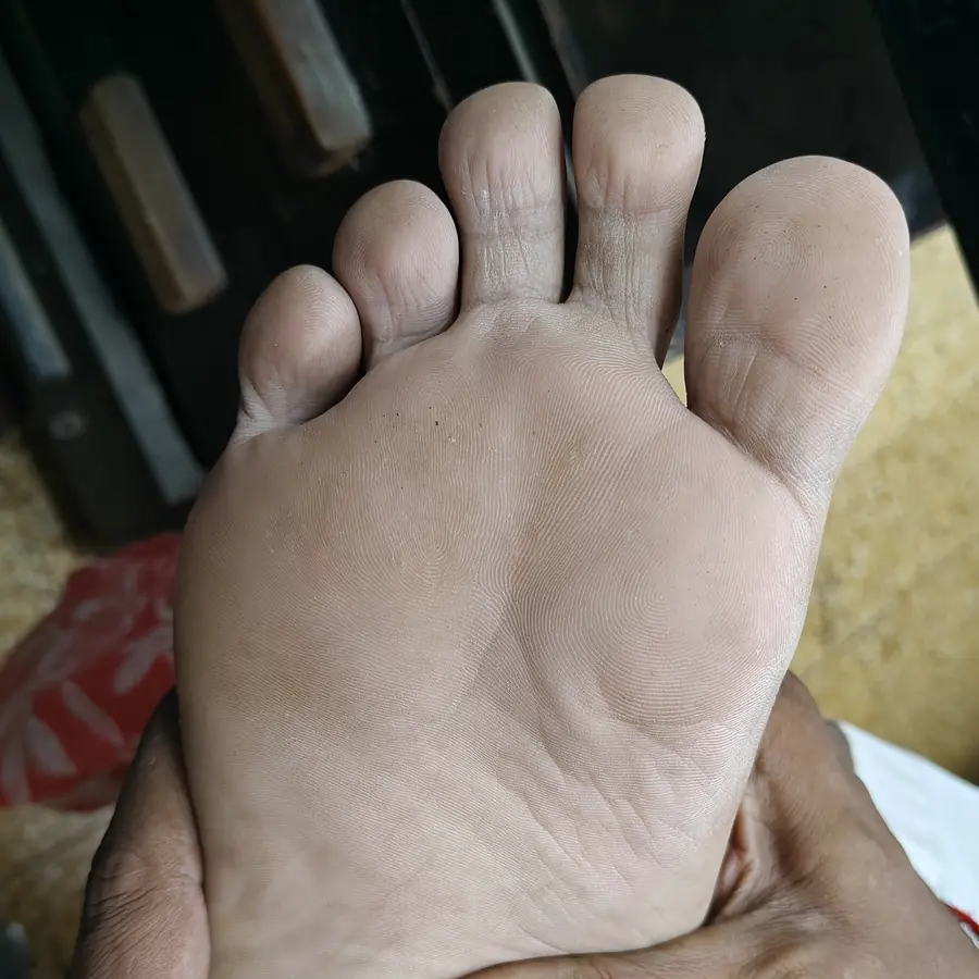 After: Pitted keratolysis (sole)
