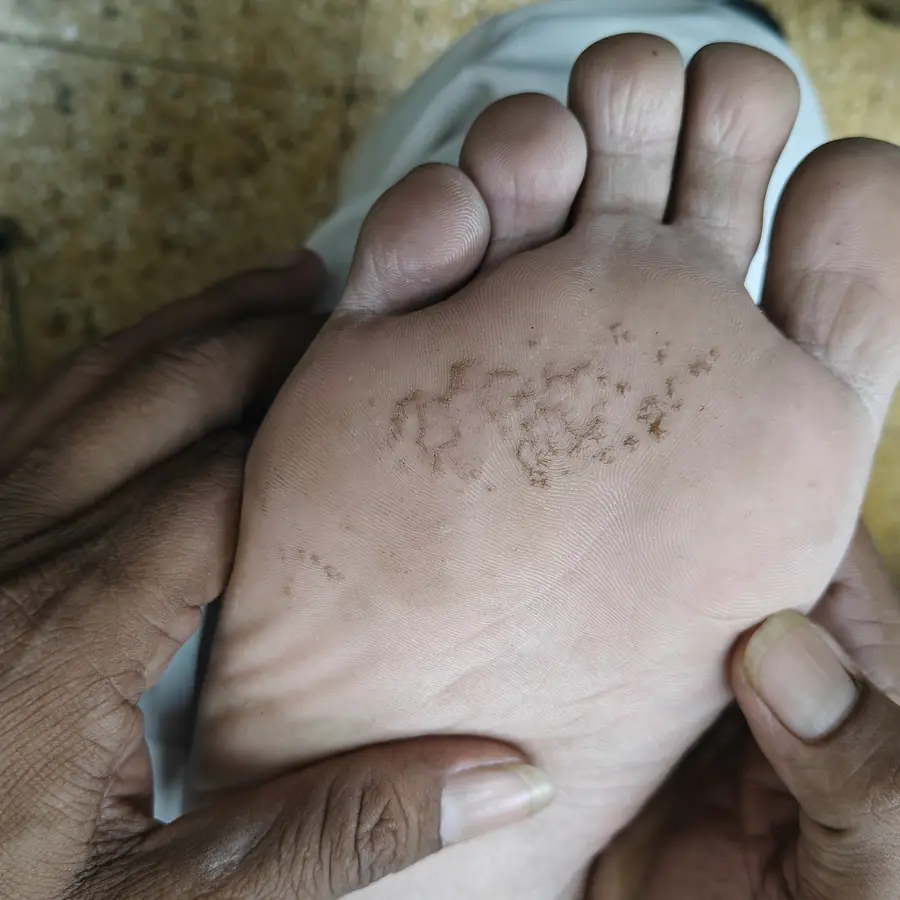 Before: Pitted keratolysis (sole)