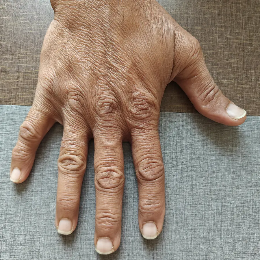After: Hand dermatitis