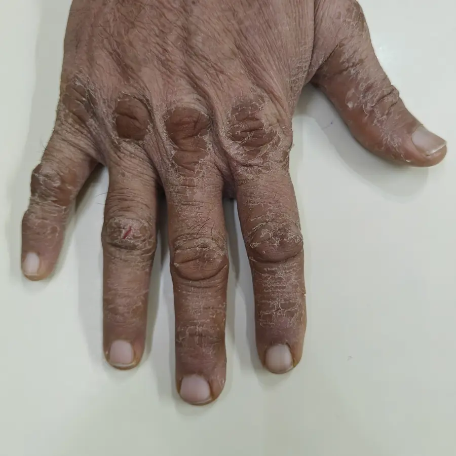 Before: Hand dermatitis