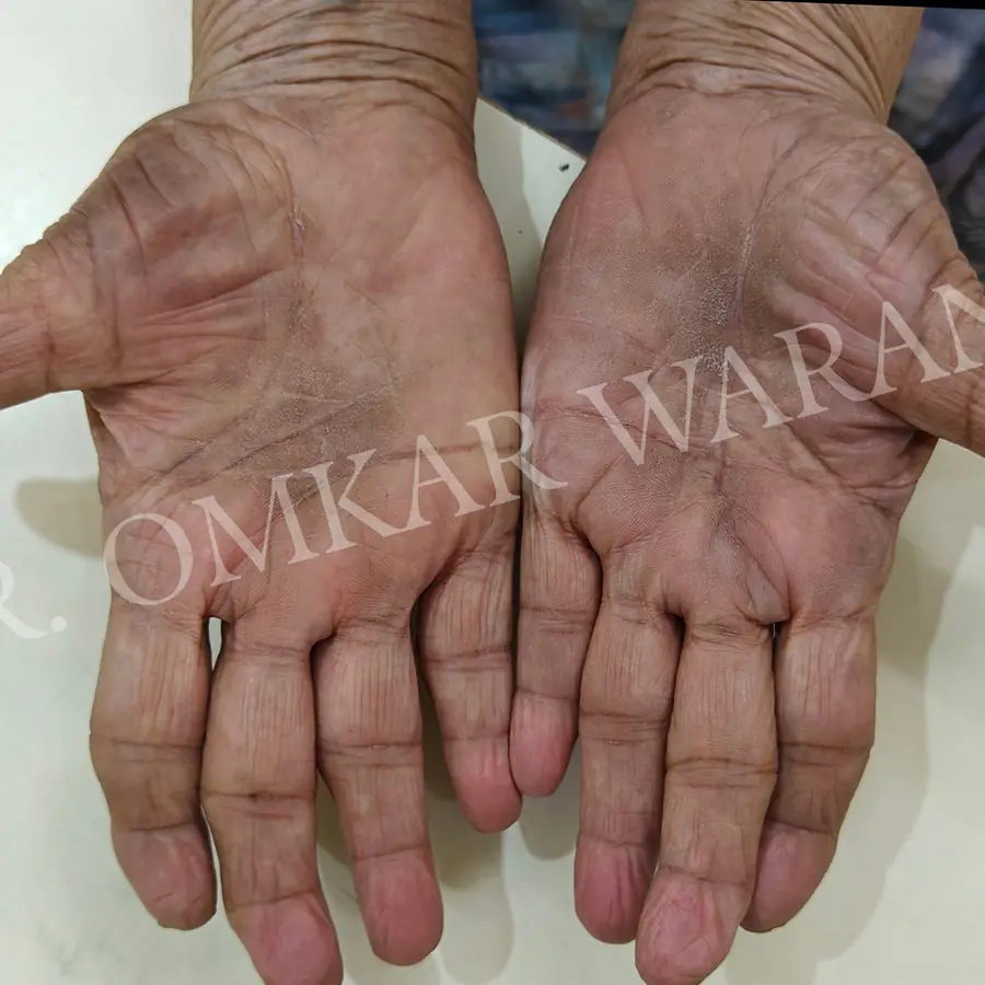After: Psoriasis on both palms