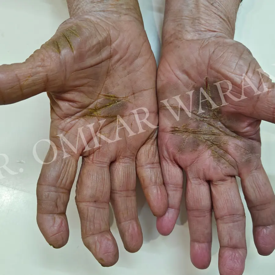 Before: Psoriasis on both palms
