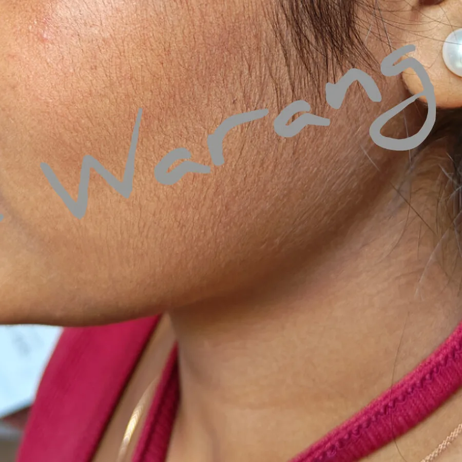 After: Acne