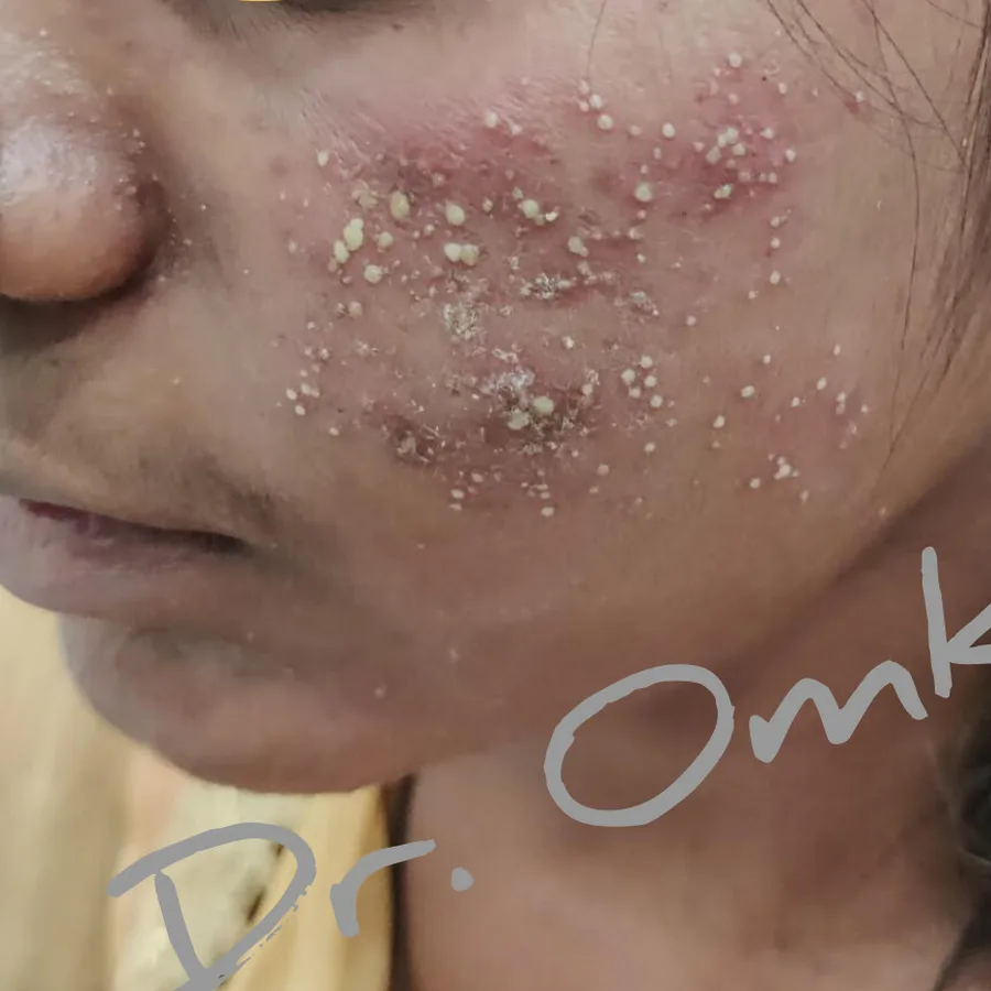 Before: Acne