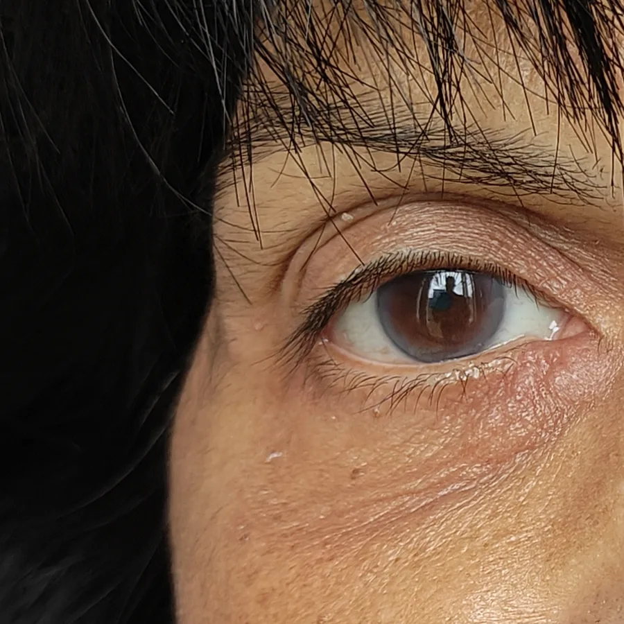 After: Allergic reaction around the eye