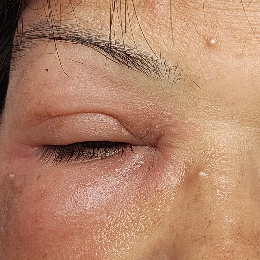 Before: Allergic reaction around the eye