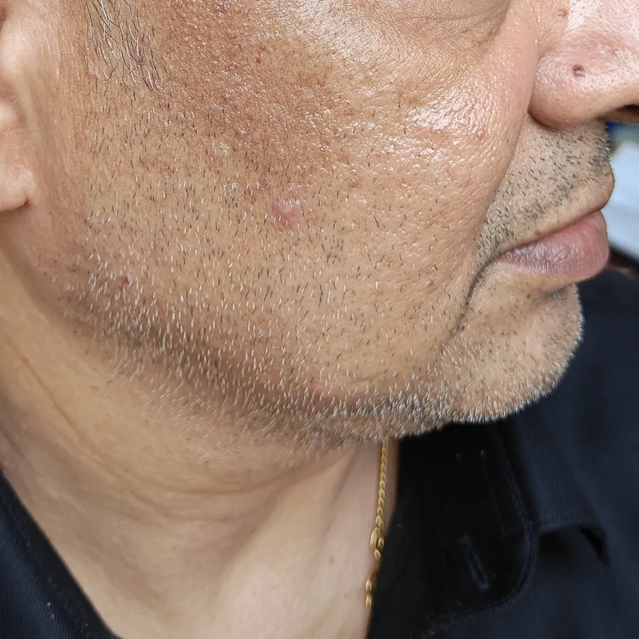 After: Pigmentation on the cheek