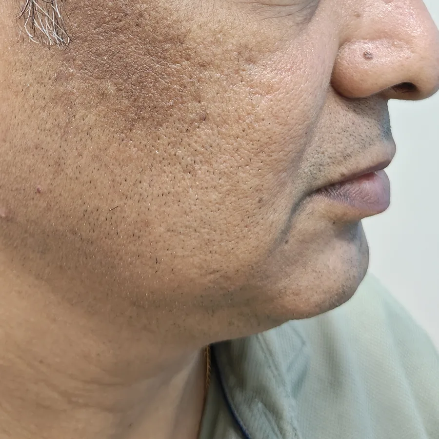 Before: Pigmentation on the cheek