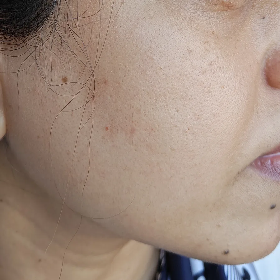 After: Uneven skin tone