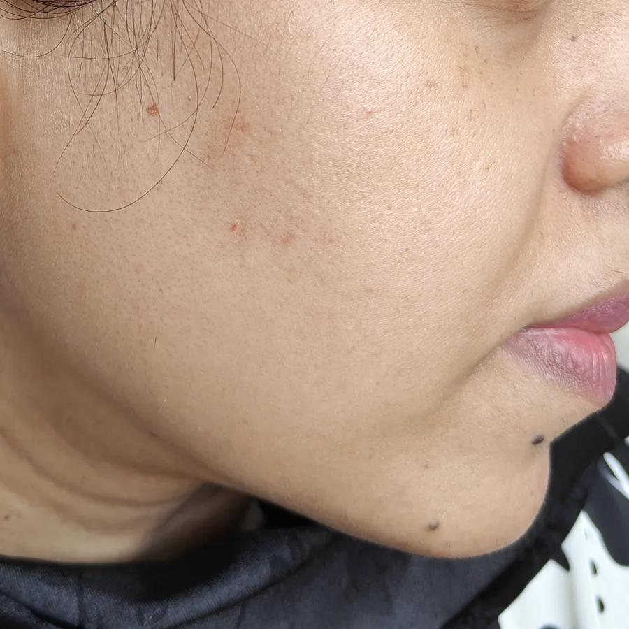 Before: Uneven skin tone