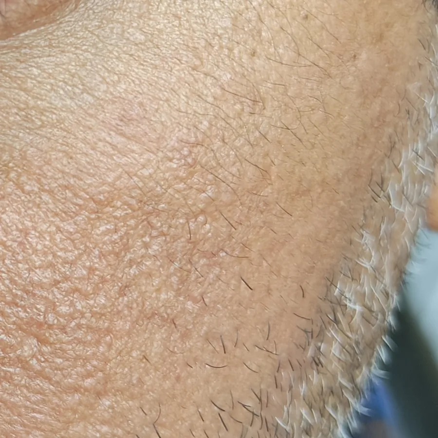 After: Scar on the cheek