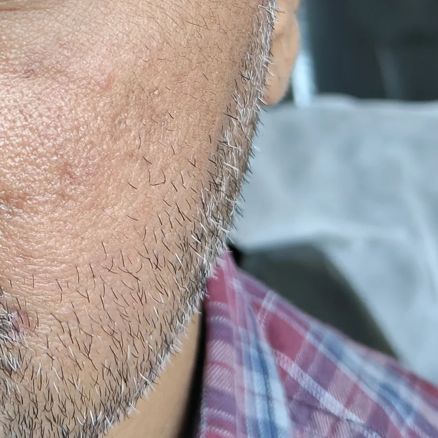 Before: Scar on the cheek