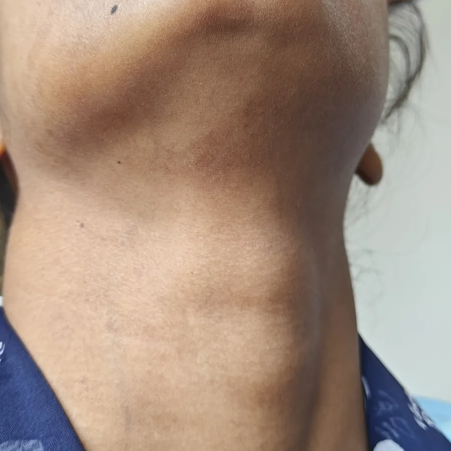 After: Fungal infection on the neck