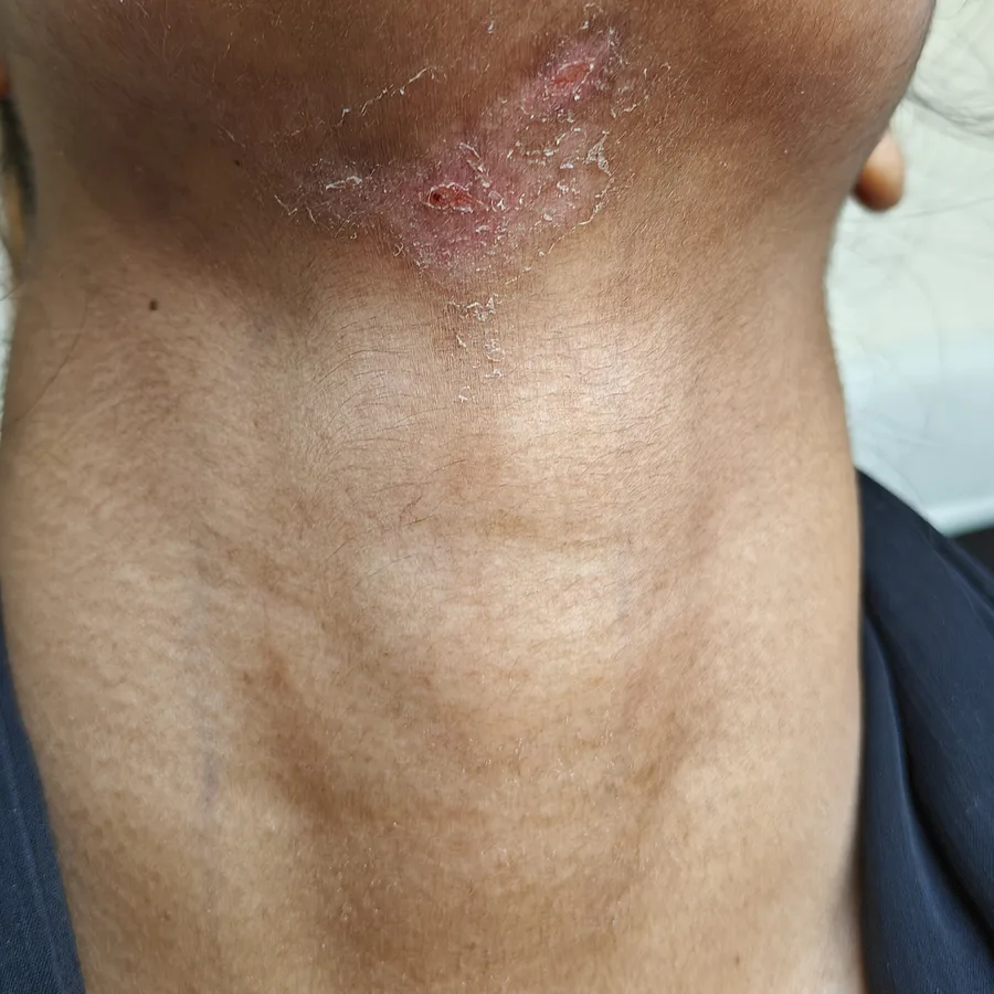 Before: Fungal infection on the neck