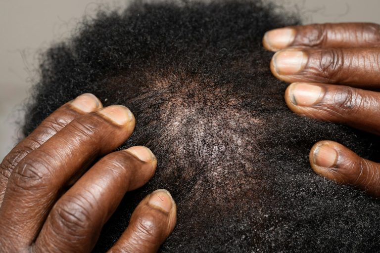 Hands parting hair to examine the scalp closely