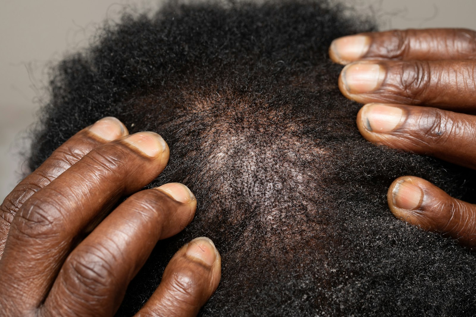 Hands parting hair to examine the scalp closely