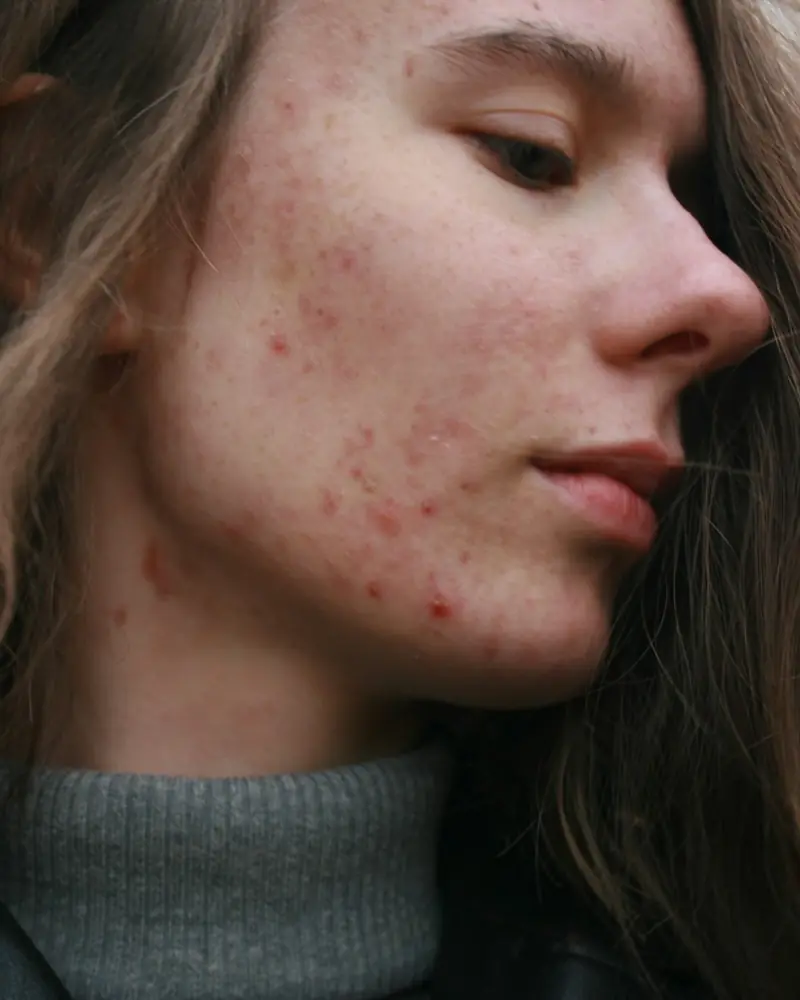 Acne on a young woman's cheek