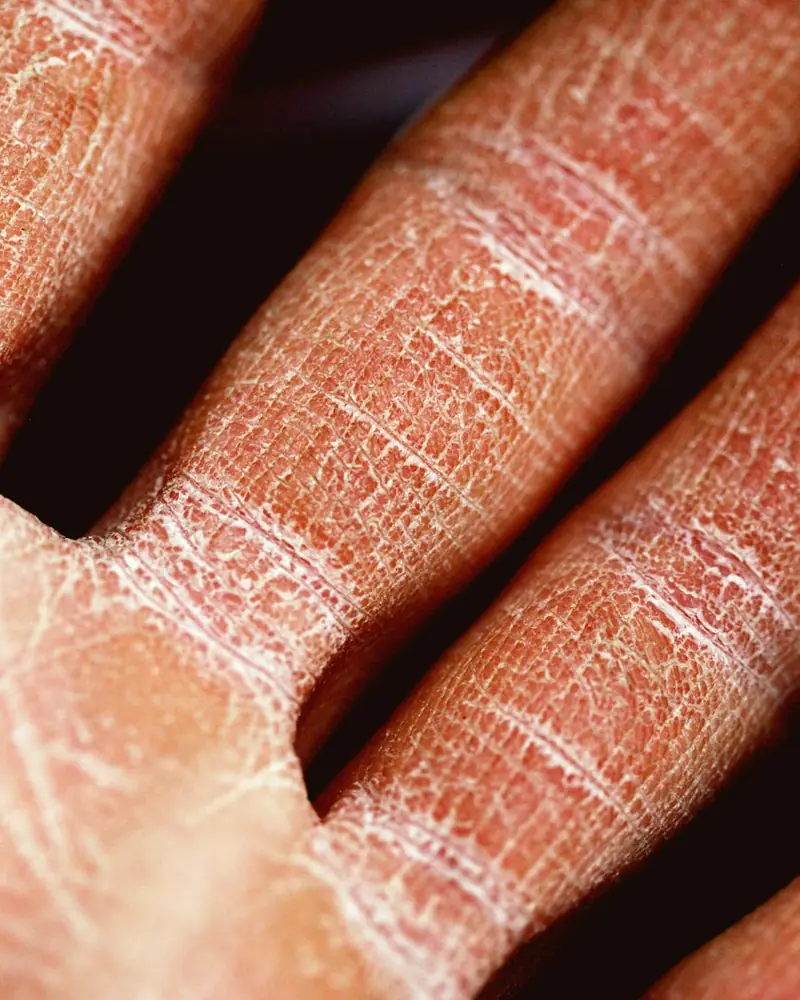 Dry, scaly skin on a hand