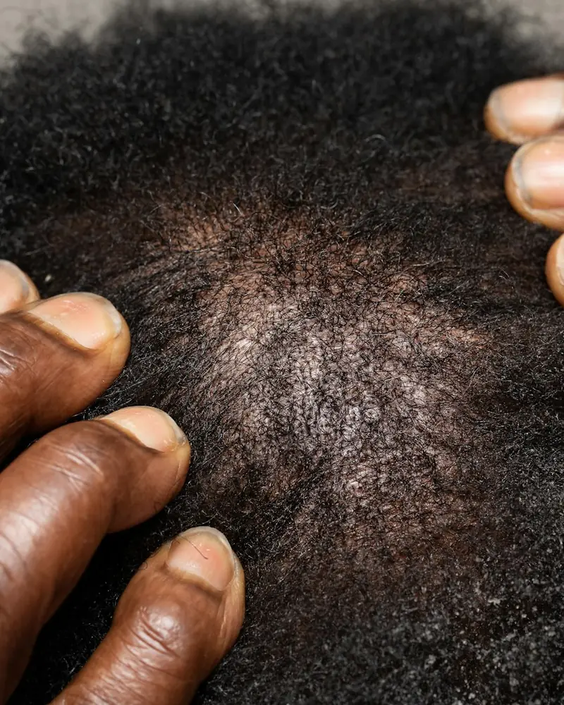 Close-up of a scalp being examined