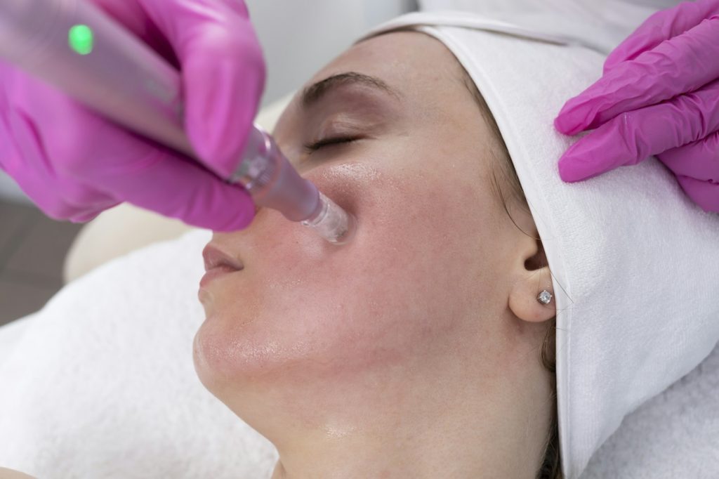 Microneedling treatment on the face