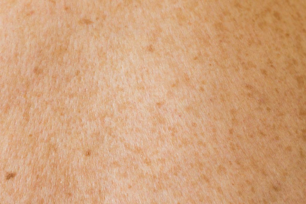Close-up of skin with freckles and uneven tone